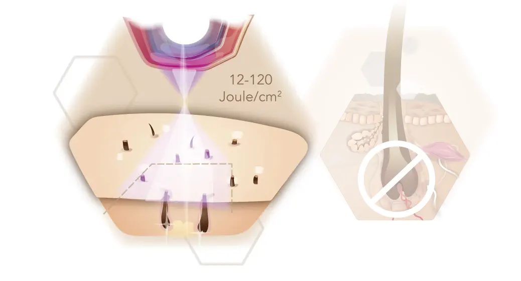 Infografik Energie Wellenlänge IPL Haarentfernung