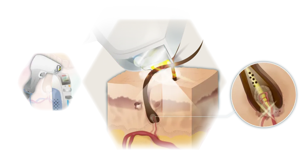 Infographic mode of action Diode laser