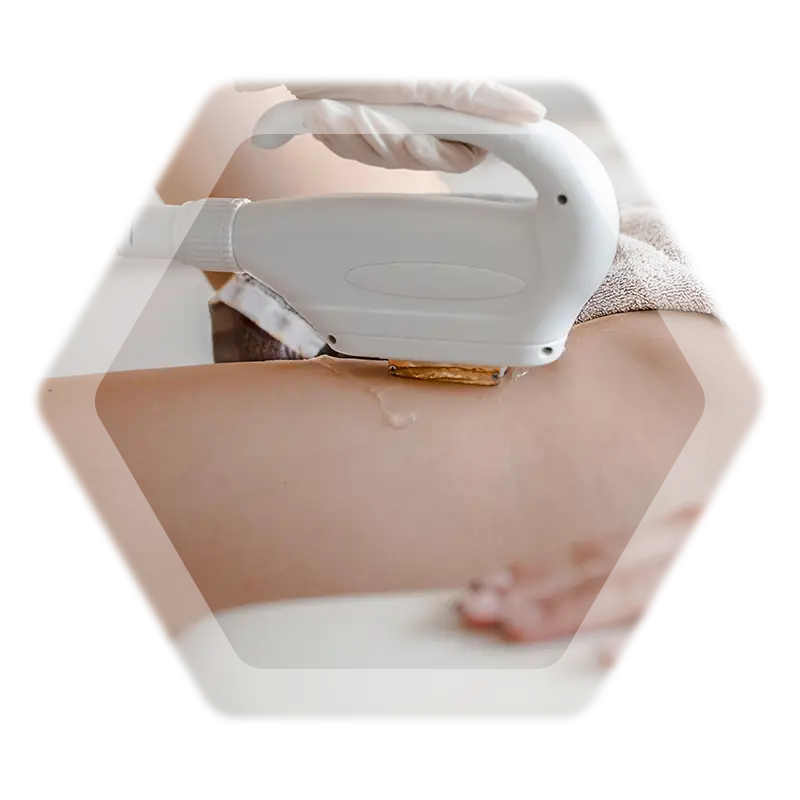 Foto Behandlung Fotoepilation