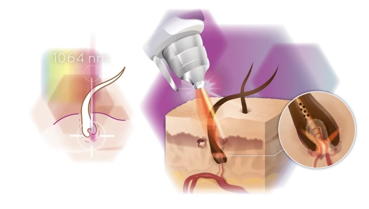 ND-YAG Laser Infografik Behandlung